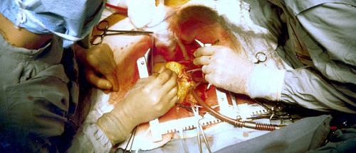 Statins Inhibit Vitamin K2 and Stimulate Hardening of the Arteries:  New Review Paper